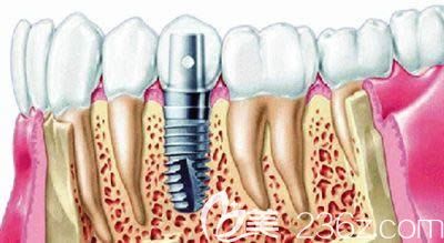 牙齿种植是否会发生并发症呢