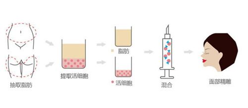 麻医生做自体脂肪移植手术步骤简易图