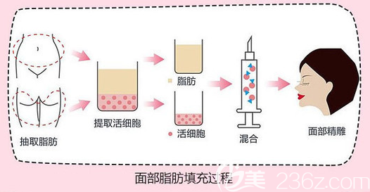 江门梦想周俊医生脂肪填充过程