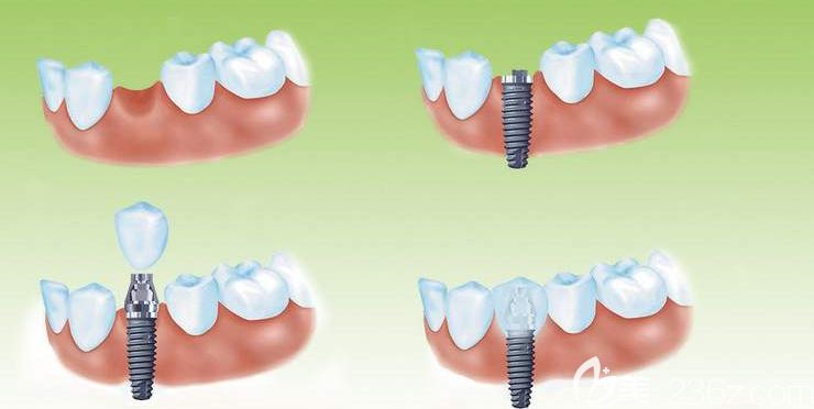种植牙操作过程