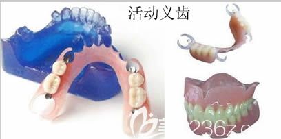 活动义齿修复展示图