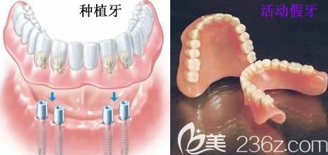 全口种植牙和全口活动假牙对比图