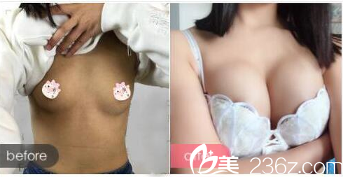 广州曙光张元龙教授做的假体隆胸案例