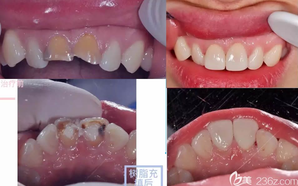 广州圣贝口腔蔡菁菁根管治疗和5D瓷睿刻修复案例图