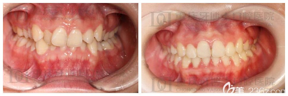 重庆牙博士口腔牙齿矫正怎么样？刘永桂正畸案例效果公布