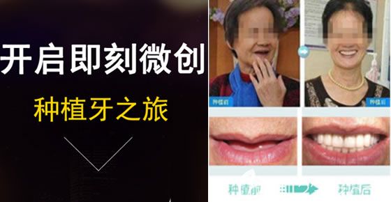 北京圣贝口腔刘希云即刻种植牙前后对比效果