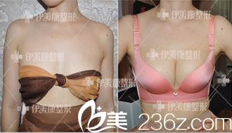 北京伊美康整形黄元生脂肪丰胸案例