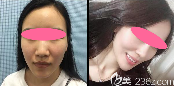 南昌大学医疗美容郭学永鼻综合手术两个月效果对比图