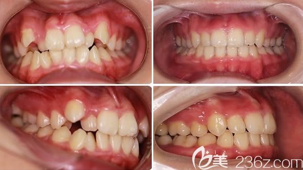 郭淑苹医生26岁顾客牙齿拥挤矫正前后对比效果
