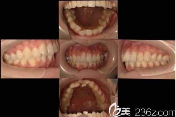 在天津美奥口腔医院矫正前的牙齿情况