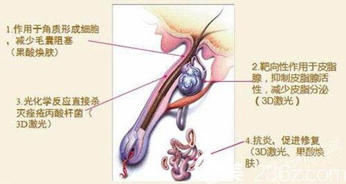 陈瑞娟医生采用激光祛痘效果显著