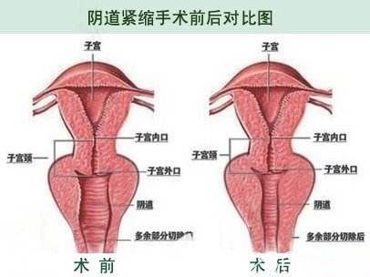 武汉硚口卓美吴秀英院长讲解私密整形紧缩术后区别