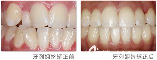 牙齿拥挤矫正前后对比图