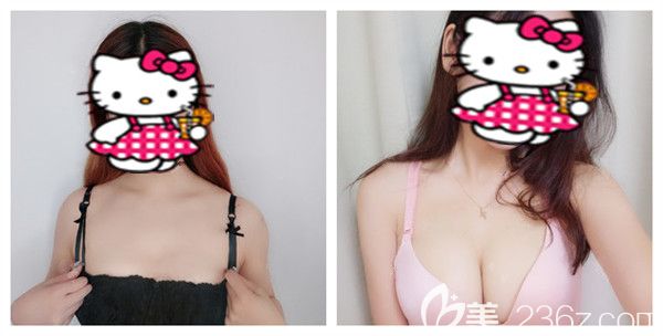 十堰中爱铭医付荣峰主任自体脂肪丰胸术后案例对比图