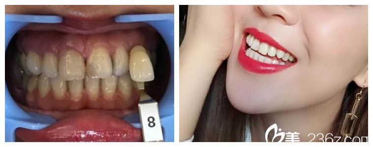 程红梅牙齿冷光美白治疗前后效果对比图