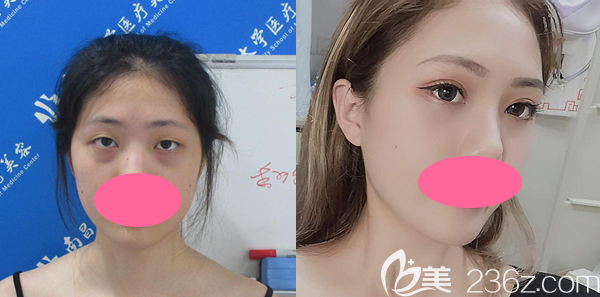 南昌大学医疗美容郭学永全切双眼皮1个月恢复效果图