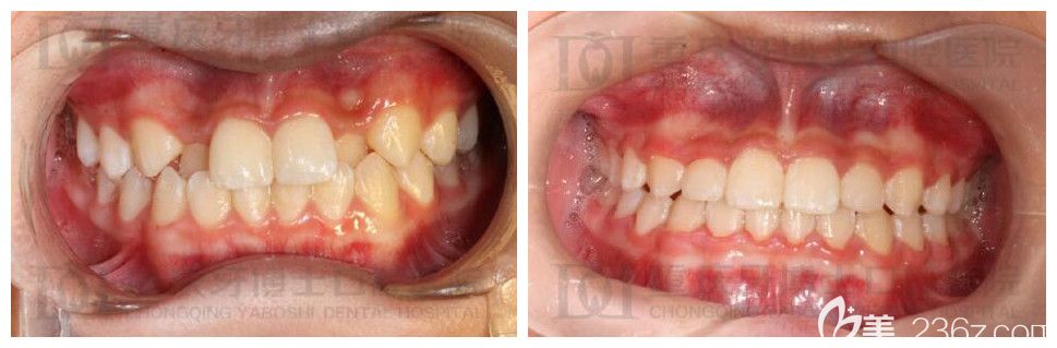 重庆牙齿矫正哪家强？牙博士刘永桂正畸案例实力验证