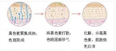 遇见美整形医生宋丹做激光斑斑过程