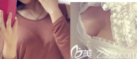 谢小禹医生丰胸案例