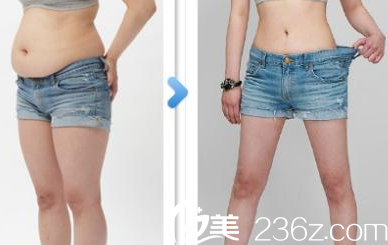 谢小禹医生吸脂塑形案例