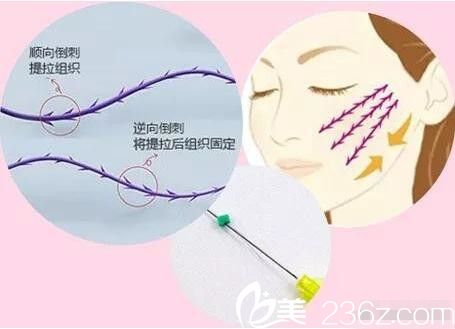 上海韩镜医疗美容医院尹弘锡面部线雕是什么？
