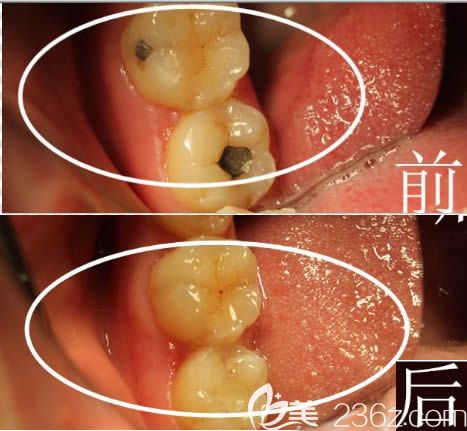 儿童补牙前后对比效果图