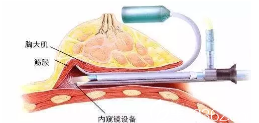 北京中日友好医院整形外科内窥镜隆胸示意图