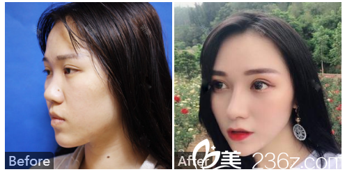 广州壹加壹整形外科李明主任肋软骨鼻综合隆鼻案例效果图片