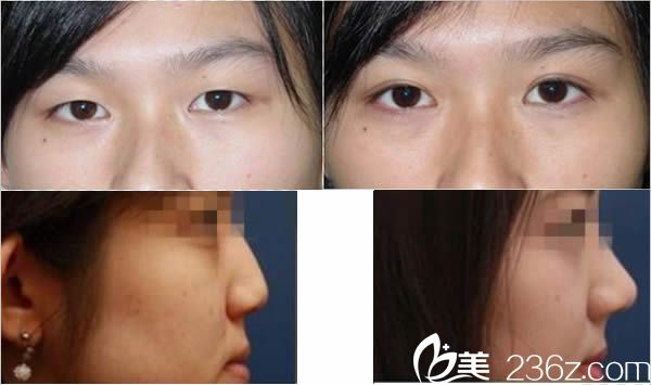 福州医院整形科郭国祥双眼皮和鼻综合隆鼻案例