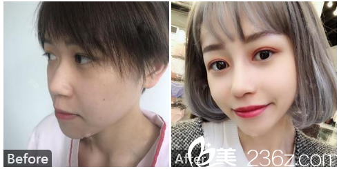 广州壹加壹整形外科李明医生做的膨体隆鼻案例图