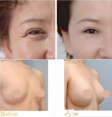 福州市医院刘鸿眼角纹除皱和假体隆胸案例
