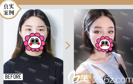 双眼皮案例重庆军美胡金香