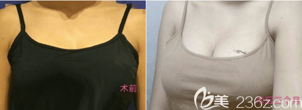 北京八大处穆大力医生内窥镜曼托假体隆胸案例