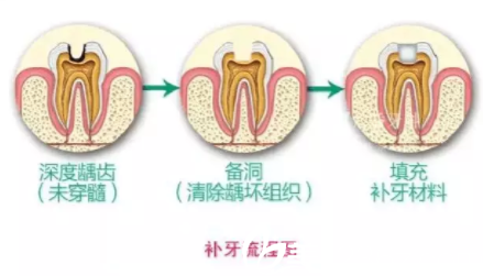 补牙示意图