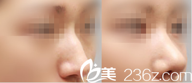 北京杨仁宝医疗美容诊所鼻型矫正案例