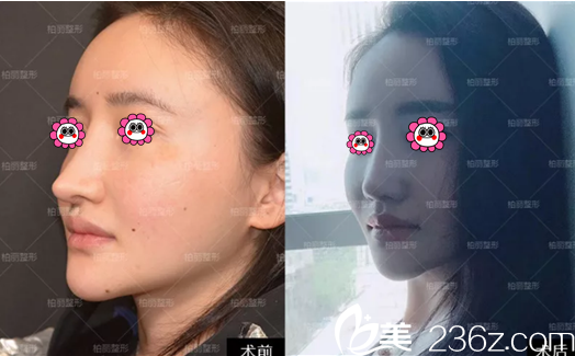 北京柏丽李劲良医生鼻修复案例