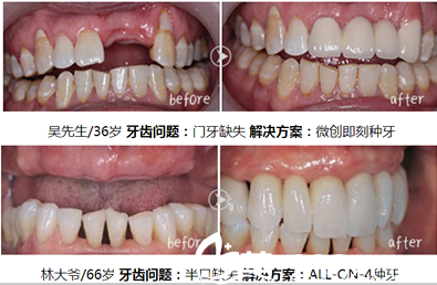 属于合肥美奥口腔医院牙齿种植案例前后对比图
