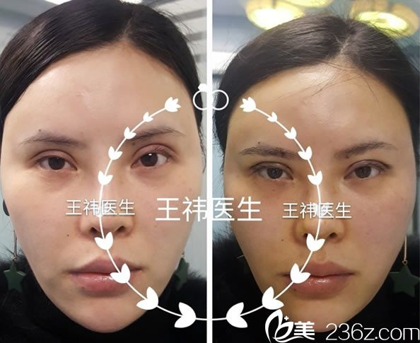 温州艺星王祎医生双眼皮修复案例