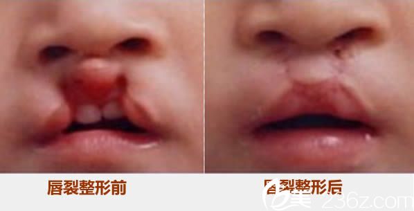 陈国鼎兔嘴唇裂修复前后对比图片
