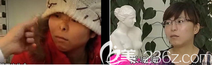 张庆国院长隆鼻案例