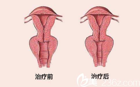 张锦峰教授做阴道紧缩术前后对比