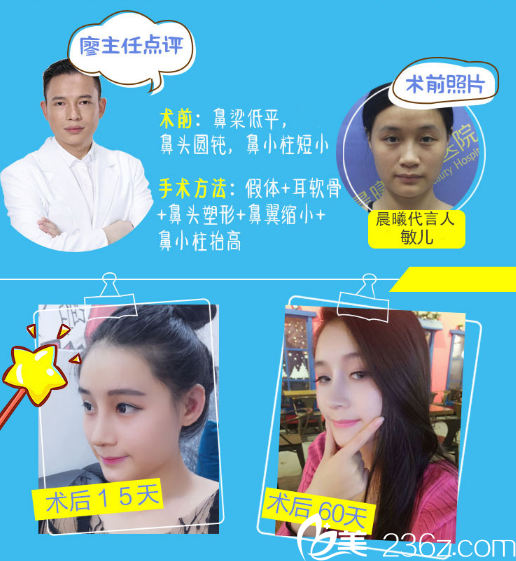 广州晨曦医疗美容医院廖轶平医生隆鼻案例