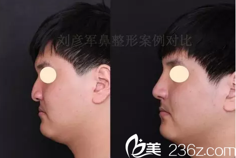 北京沃尔整形刘彦军鼻畸形修复案例