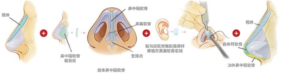  吴蒙 高难度鼻修复技术 