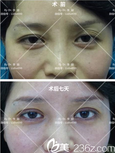 李喆教授双眼皮修复案例