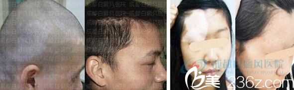 王平远植发及白癜风治疗效果展示