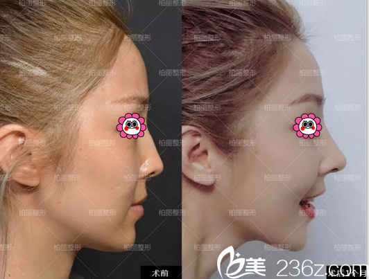 北京柏丽李劲良医生鼻综合案例