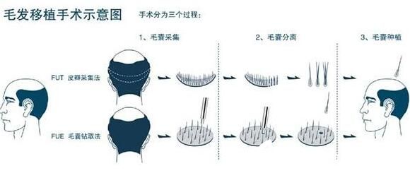 长春海峡整形医院医生讲解毛发移植