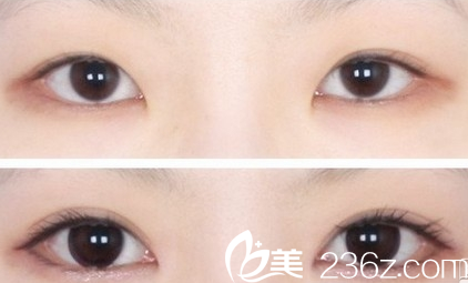 广州壹加壹项美莲埋线双眼皮失败修复案例