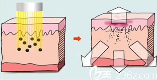激光祛黄褐斑原理